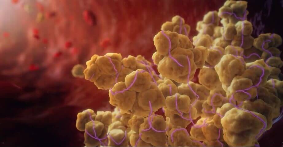 TTP is unpredictable. Understand the causes and risks of microthrombi. 